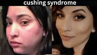 Cushing Syndrome Symptoms, Causes and Treatment
