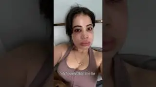 Urfi Javed Reveals Before & After Look Post Filler Removal 😬 | Shocking Transformation! #shorts