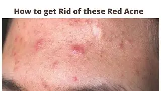 Remove Red acne with this Remedy easily
