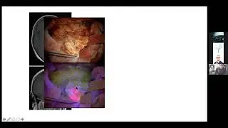 Journal Club #5 - The BRAIN-MATRIX Trial with Professor Colin Watts