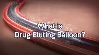 What is Drug Eluting Balloon?