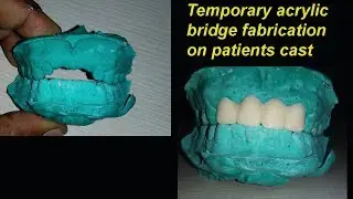 Temporary acrylic bridge fabrication technique on the cast very easy method