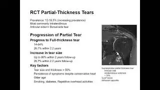 ASO_SH RCT Partial Tear Shoulder Rotator Cuff Tendon Partial-thickness Tear