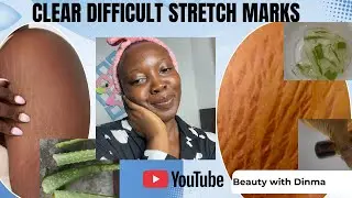 How to Get Rid/Clear Difficult Stretch Marks on Your Skin. #skincare #viralvideo #youtube #diy #skin