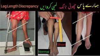 Limb Length Discrepancy