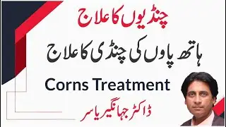 Hath Paon Ki Chandi Ka ilaj | Chandiyon Ka ilaj| Corns removal Remedies | DRJAHANGIRYASIR