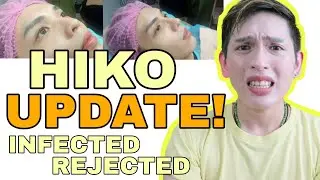 HIKO NOSE THREAD UPDATE + Q&A | INFECTION VS REJECTION! NON-SURGICAL NOSE LIFT | MUST WATCH**