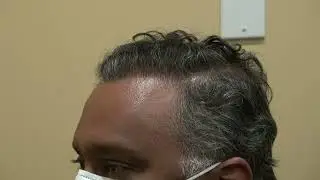 Profile View Hair Transplant | 1-Year FUE Result with Natural Density and Youthful Framing
