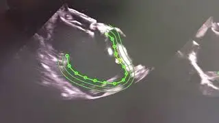 2D Speckle Tracking Strain of RV Pre and Post PFO Closure!!