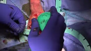 Penile Implant in Man with 