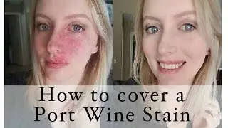How to cover a Port Wine Stain birthmark