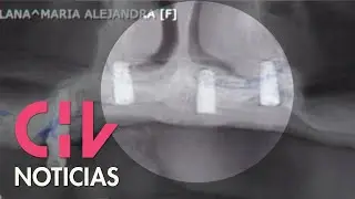 Las nefastas consecuencias de los implantes dentales mal puestos