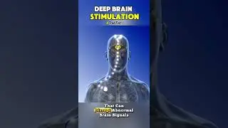 Brain Chip Zaps Anxiety & Parkinson's Tremors! 😲 DBS Implant Explained #deepbrainstimulation #facts