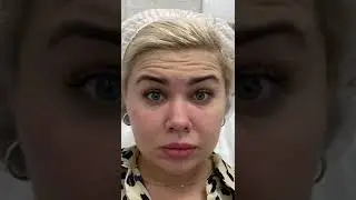 Ботулинотерапия Full Face