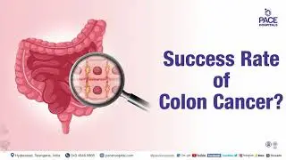 Success Rate of Colon Cancer | What is Success Rate of Colon Cancer? Dr. Phani Krishna Ravula