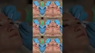 Brow Lift Botox: Lateral Lift, Microinjection & Safety Tips | Aesthetic Short #aestheticdoctor