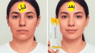 وداعًا لآثار حب الشباب والندوب  Contractubex Gel الحل الفعّال لبشرة ناعمة وصافية