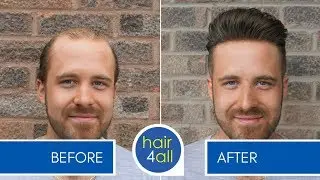Before & After a Non-Surgical Hair Replacement System for Men/Women (Hair Loss/Baldness/Hair System)