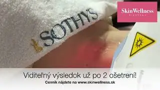 IPL odstr&aacute;nenie chĺpkov v Skinwellness Pie&scaron;ťany