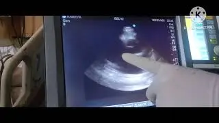 Critical Care Echocardiography// Bedside Echo// POCUS