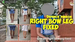 Defence person from uttar pradesh fixed  right bow leg. Second leg will operate After 2 months