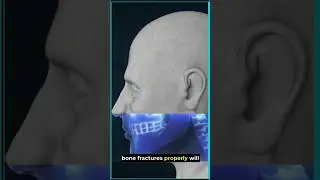 Facial Bone Fractures Explained: Why Treatment is More Important Than You Think 🦷✨