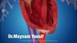 Pulmonary valve replacement by Melody
