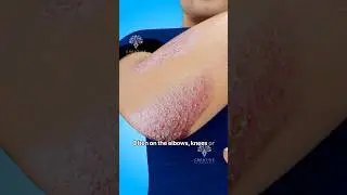 How Does Psoriasis Happen #shorts #viralvideo #skincare - Creativelearning3d