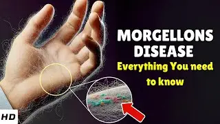 Болезнь Моргеллонов &ndash; причины, признаки и симптомы, диагностика и лечение