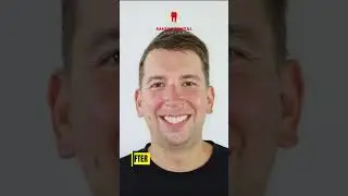 A Stunning Transformation After Dental Implants and Crowns #dentist #smiletransformation #implant