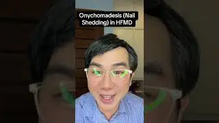 Onychomadesis or nail shedding in hfmd