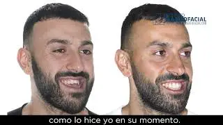 Cirugía ortofacial. Caso # 86: Giuseppe - Clase III, asimetría facial, mordida abierta