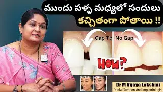 Best Teeth Gap Treatment | Diastema | Gap Teeth Filling | Palla Sandulu in Telugu | Vijaya Dental