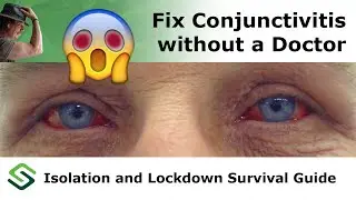 Fix Conjunctivitis (Pink Eye) at home without a Doctor - ep03 Lockdown and Isolation Survival Guide