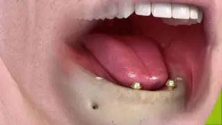 Non removable Denture Supported by 4 Dental Implants in New York