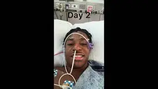 AMELOBLASTOMA I FIBULA FREE FLAP SURGERY I WIRED JAW I 1 WEEK AFTER SURGERY (REPOST)