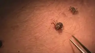 Ticks in Ohio: What to know about bites and how to stop them