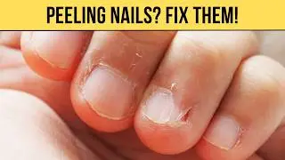 How to Fix Peeling Nails at Home: Quick Tips for Healthy Nails