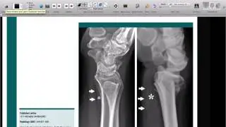 How to import pdfs into OsiriX to create great teaching cases
