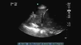 Lung consolidation on ultrasound- with air bronchogram