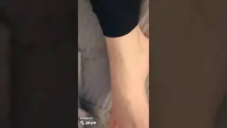 Amputee Girl Showing leg | A Girl after leg amputation showing both the legs after recovery