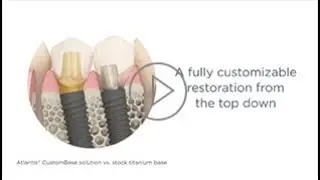 Atlantis &ndash; the first true patient-specific screw-retained solution