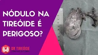 Nódulo na tireóide é perigoso? | Dr Jônatas Catunda