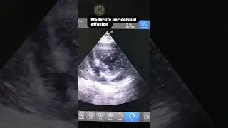 Cardiology ##2D ECHO Day 1