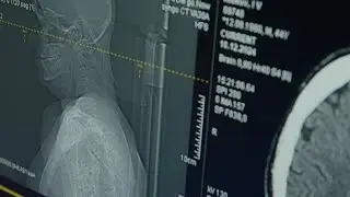Deep brain stimulation trial explores new treatment for depression