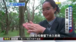 隱形燙傷風險大！ 暖暖小物可致皮膚病變  【東森深度報導】@newsebc
