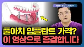 풀아치 임플란트 비용! 적정 가격 딱 정리해드립니다.