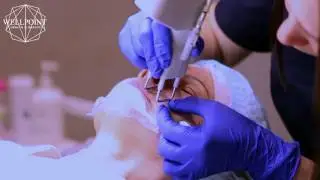 Wellpoint   12   Периоральная зона