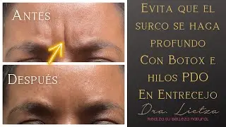 ¡Adiós a las arrugas del entrecejo! | Evita que se hagan SURCOS |con Botox 💉 e Hilos PDO 🧵