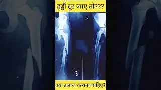 #shorts #short #trending #viral #orthopaedics #trauma #fracture #femur #children #childinjury #yt